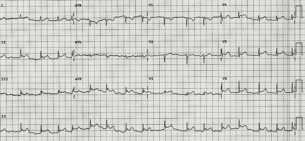 Cureus | Pericarditis of Polyarteritis Nodosa