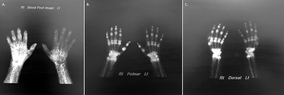 Cureus | Reflex Sympathetic Dystrophy of the Right Hand following an ...