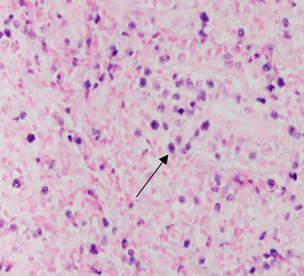Cureus Aggressive Biology of ExtraNodal NK/T Cell Lymphoma A Case