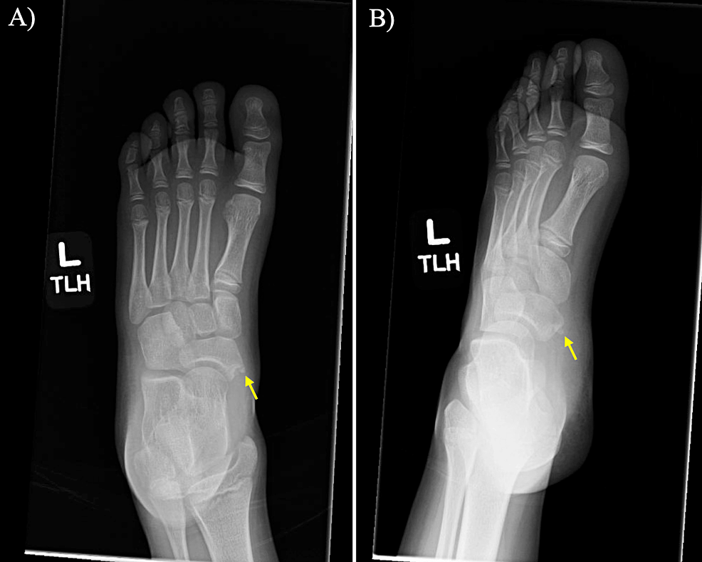 Cureus Symptomatic Patient With Two Separate Accessory Navicular Bones