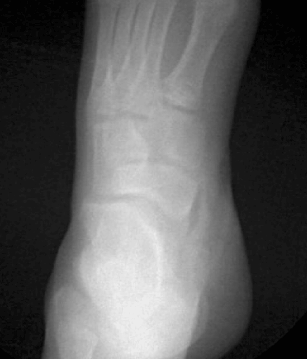 Cureus Symptomatic Patient With Two Separate Accessory Navicular Bones