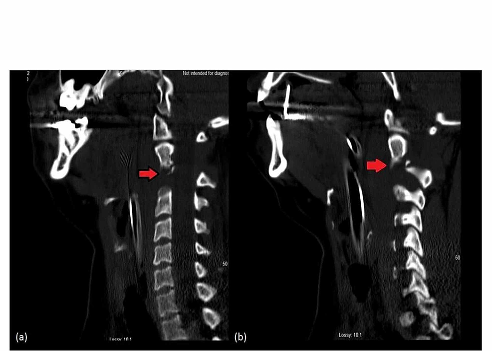 Sagittal-view-(a)-left-and-(b)-right-:-CT-cervical-spine-with-a-red-arrow-showing-C2-pedicle-fracture.
