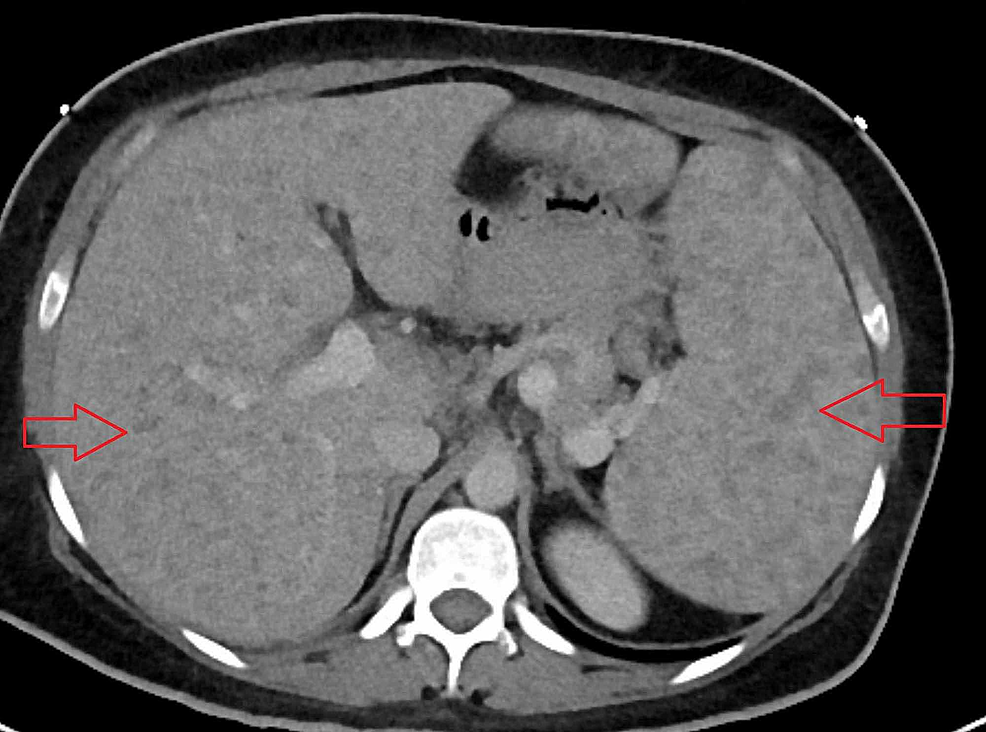 Cureus A Rare Case of Necrotizing Sarcoid Granulomatosis Involving Liver
