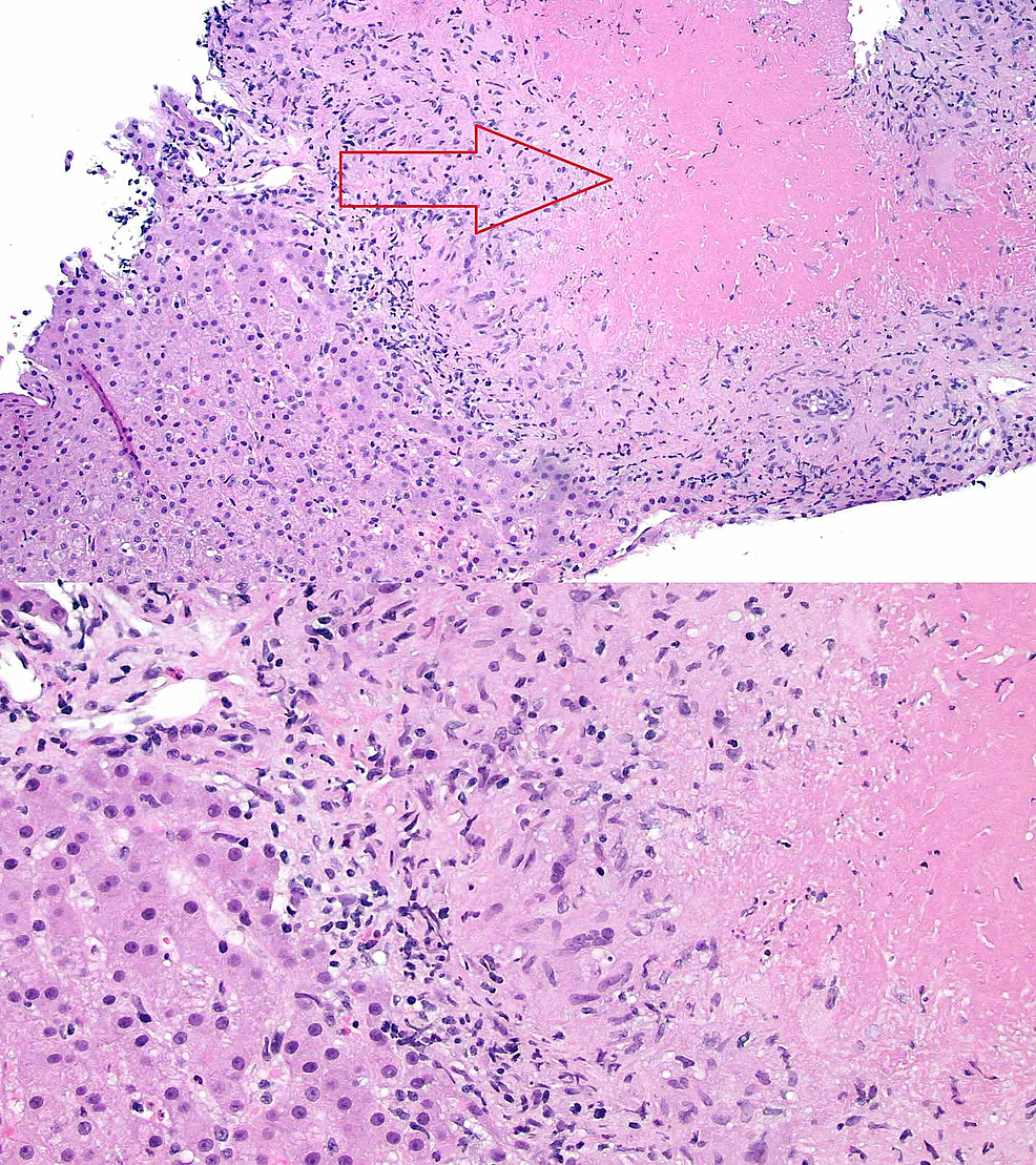 Cureus A Rare Case of Necrotizing Sarcoid Granulomatosis Involving Liver