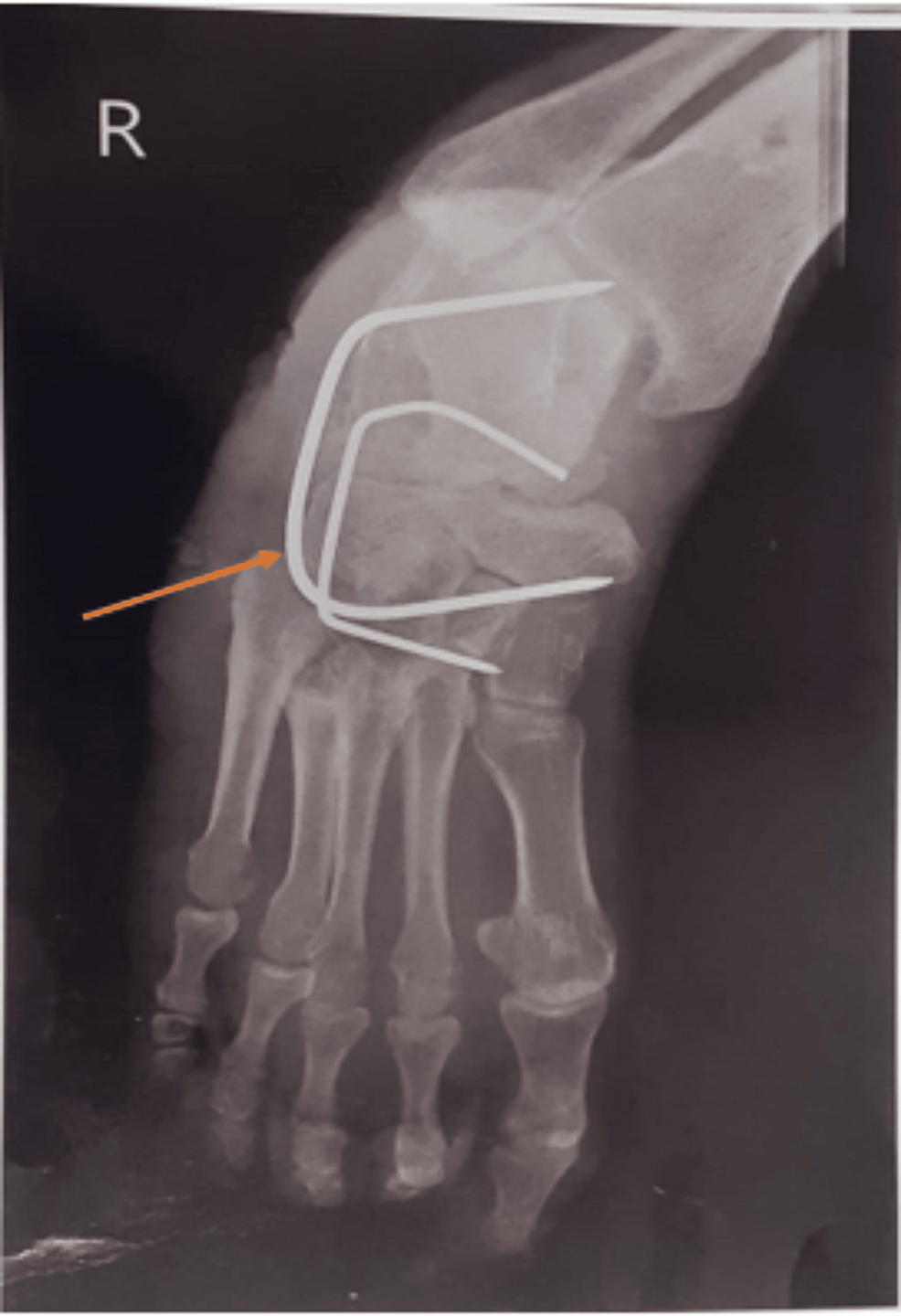 Cureus Comprehensive Rehabilitation of Charcot Foot With Equinovarus