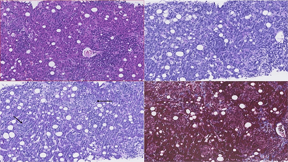 Cureus Anticardiolipin Antibody Determination to Guide Q Fever Treatment