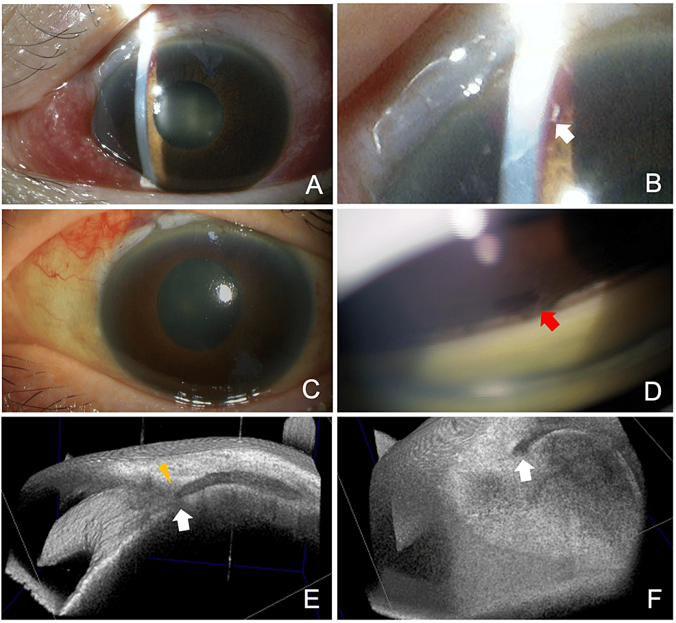 Dislocation Of The PreserFlo MicroShunt During A Postsurgical Needling ...