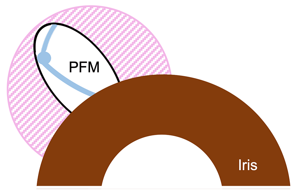 Dislocation Of The PreserFlo MicroShunt During A Postsurgical Needling ...