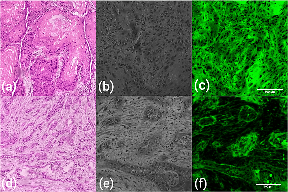 Cureus, Comparison of Clinico-Demographic and Histological Parameters  Between Young and Old Patients With Oral Squamous Cell Carcinoma
