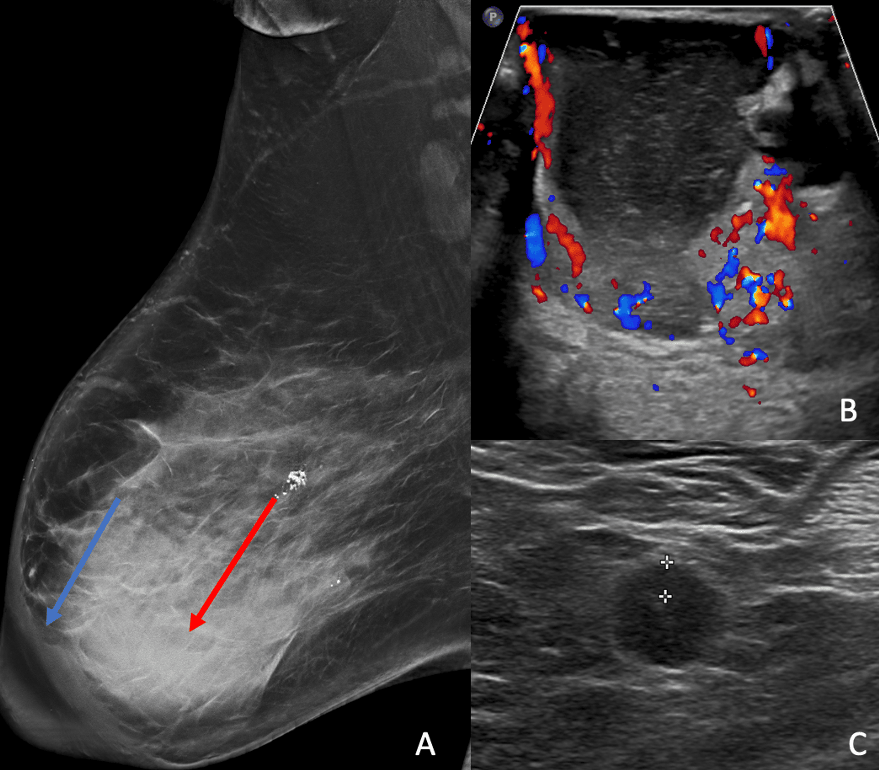 Puzzling Papillomas: A Case of an Intraductal Papilloma Mimicking an ...