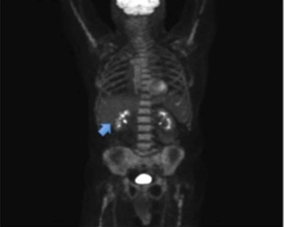 Cureus Neuroendocrine Tumor A Rare, Aggressive Tumor of the Gallbladder
