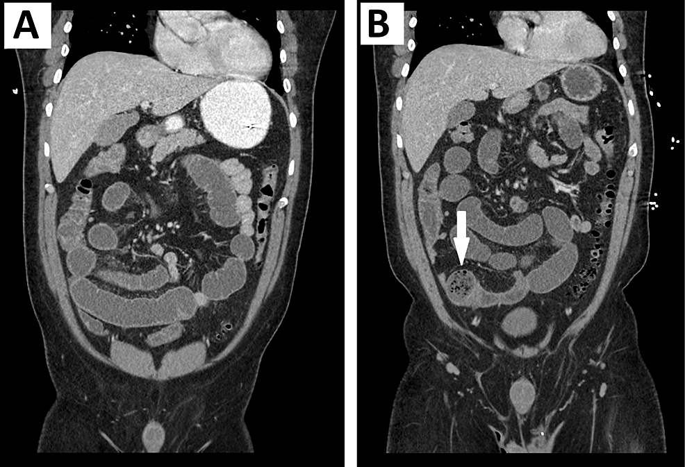 Cureus Hypothyroidism Presenting as Adynamic Ileus Mimicking a