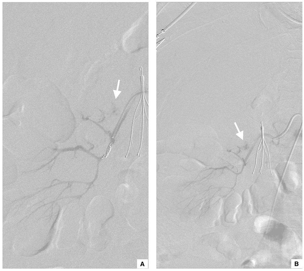 Unprovoked Spontaneous Kidney Rupture (Wunderlich’s Syndrome) Managed