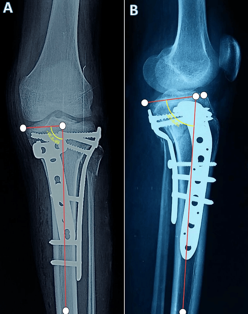 The Comparative Analysis of Single Plating Versus Double Plating in the Treatment of Unstable Bicondylar Proximal Tibial Plateau Fractures