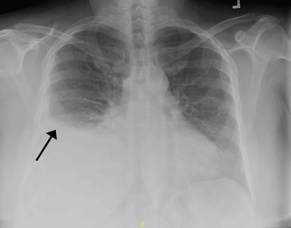 Cureus | A Case Report Describing Hemophilus parainfluenza Recovered ...