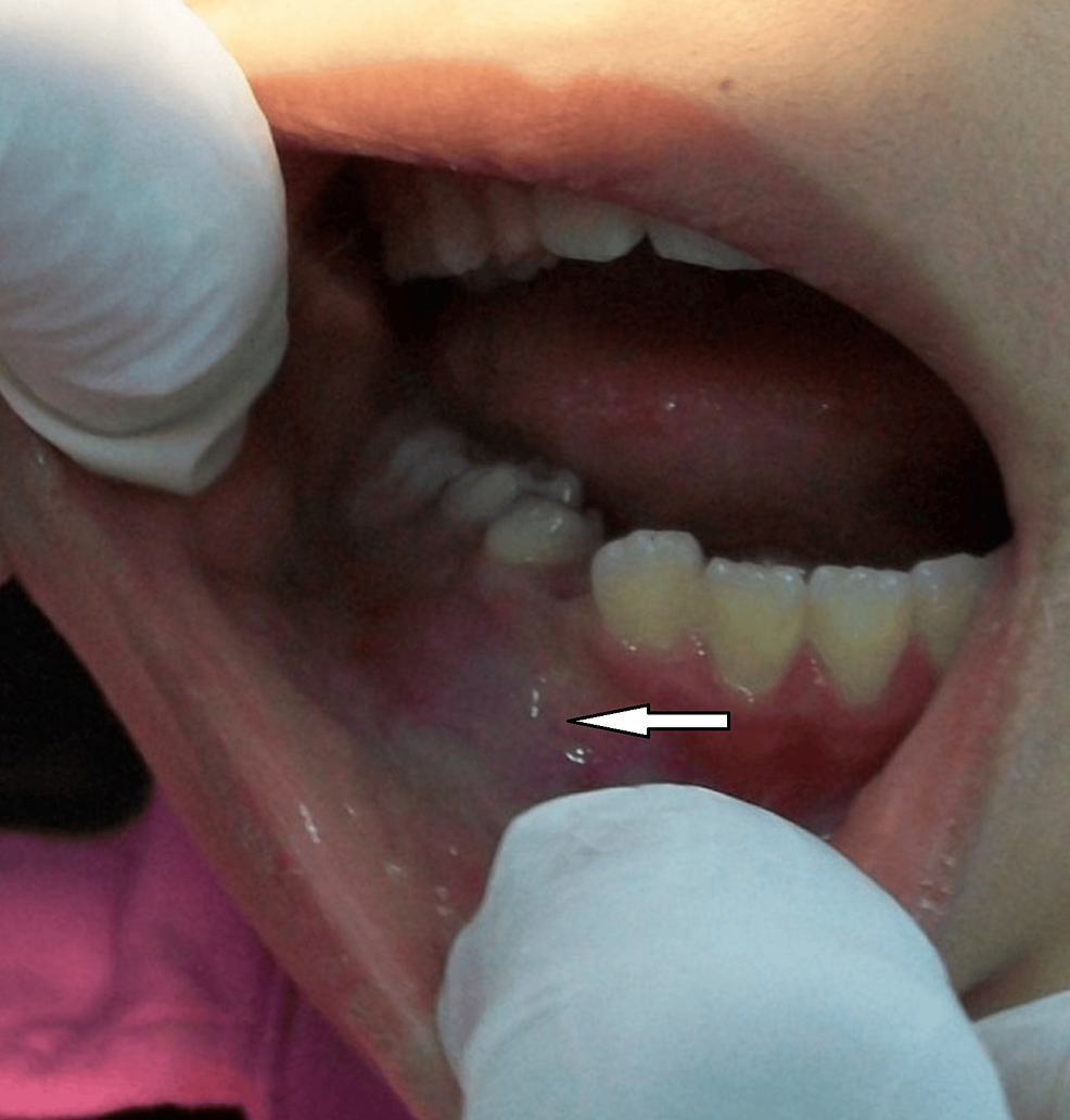 الإدارة المحافظة للكيسات السنية المرتبطة بالأسنان المختلطة: دراسة أترابية بأثر رجعي