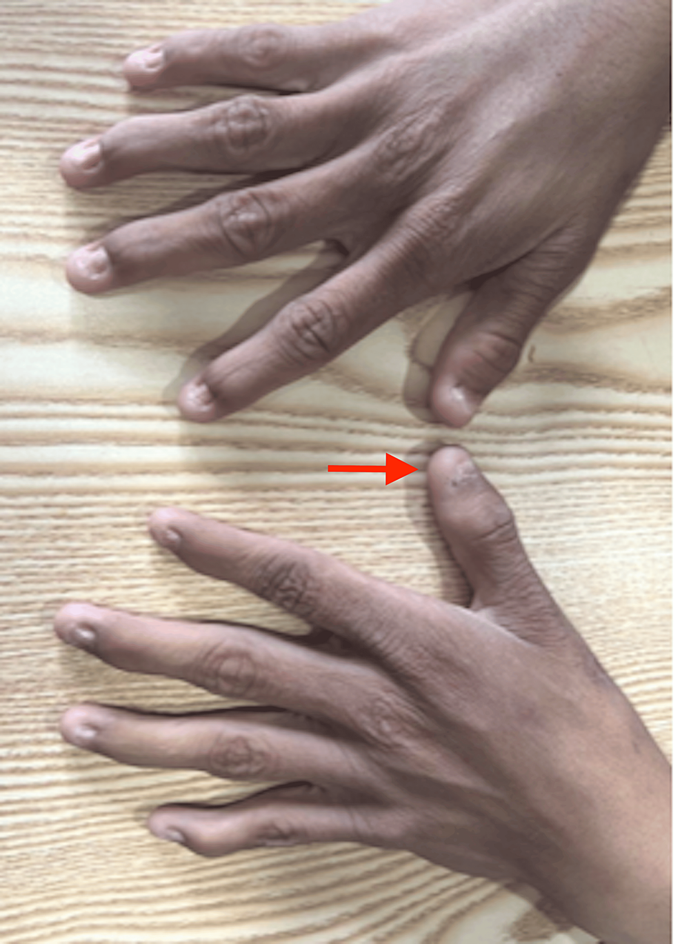 Pedigree. All black indicates the presence of nail-patella syndrome... |  Download Scientific Diagram