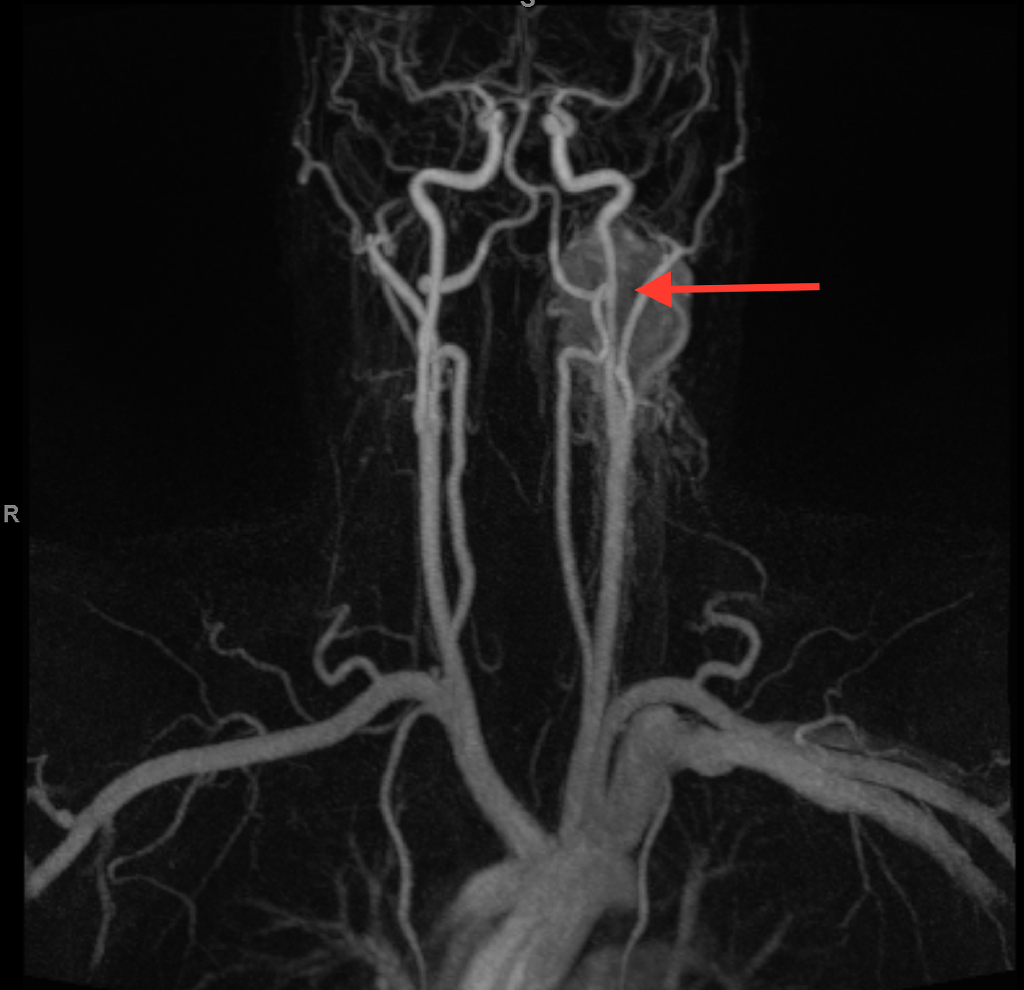 Cureus | Case of Incidental Asymptomatic Carotid Body Paraganglioma in ...