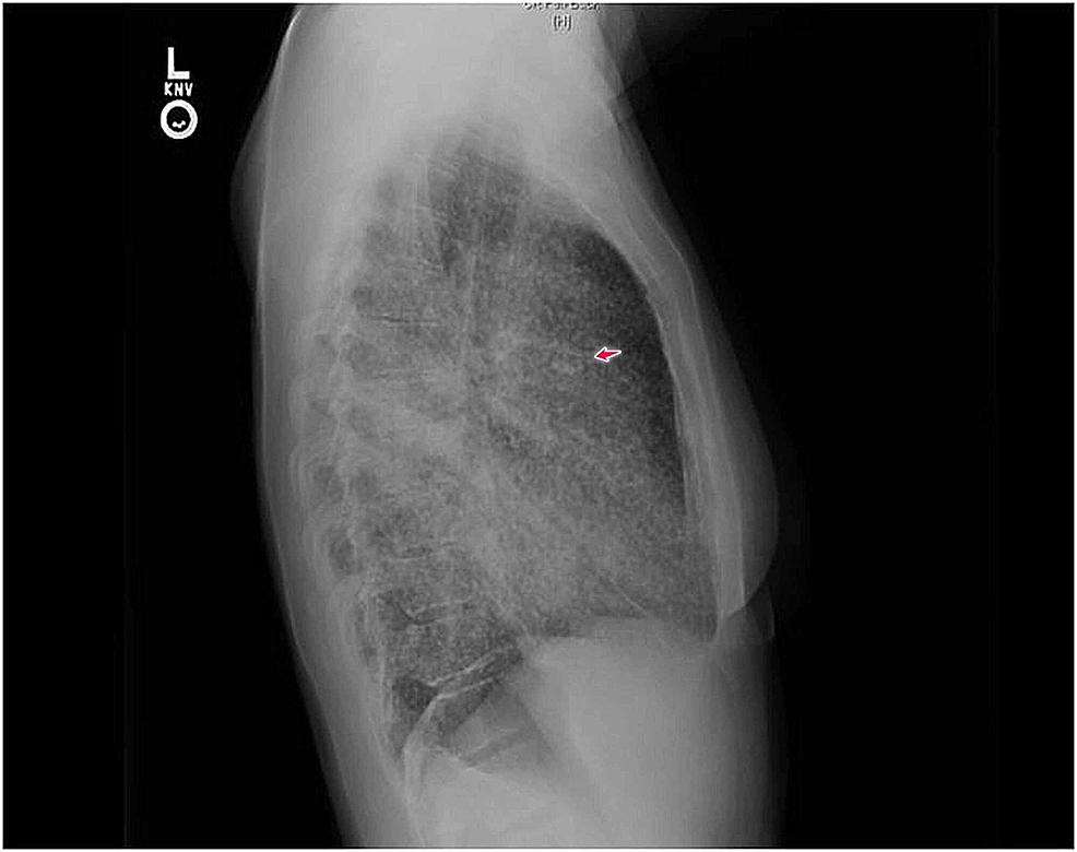 Cureus Adenocarcinoma of the Lung Presenting with Intrapulmonary