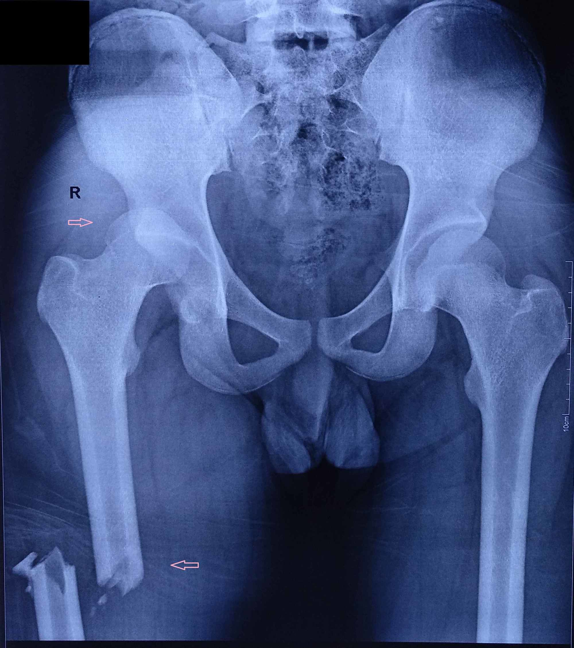 pause sanity concept Cureus | Traumatic Posterior Dislocation of Hip with Ipsilateral Fracture  of Shaft of Femur: Temporary Fixator-assisted Reduction and Final Fixation  with Interlocking Nail
