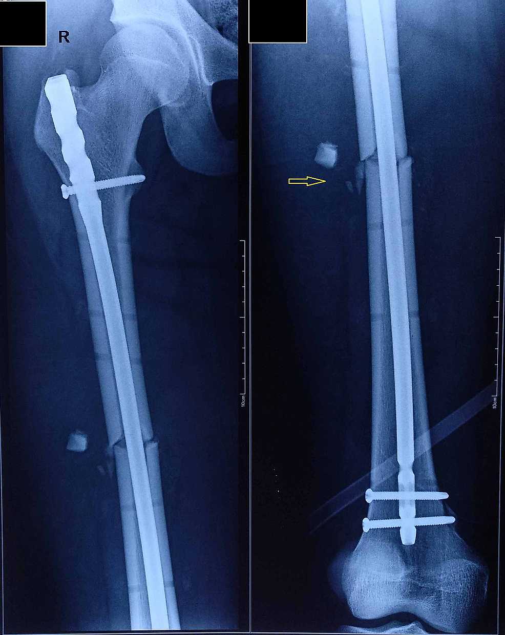 Cureus Traumatic Posterior Dislocation of Hip with Ipsilateral