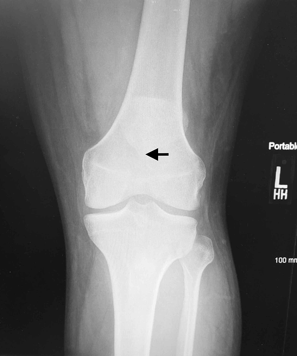 Cureus | Simultaneous Bilateral Rupture of Patellar Tendons in a Young ...