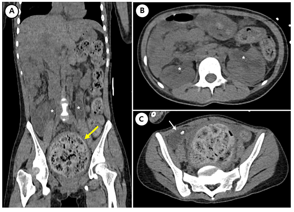 Fecal impaction, Radiology Reference Article