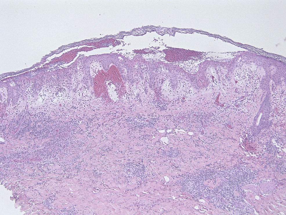 A Case of Bullous Sweet’s Syndrome Associated With Esophageal ...