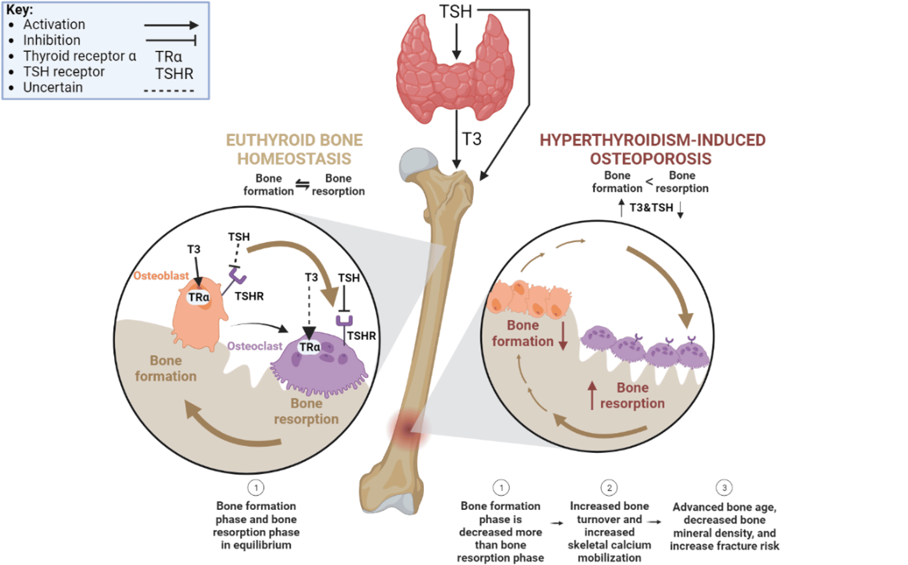 Mechanisms and Treatment Options for HyperthyroidInduced Osteoporosis