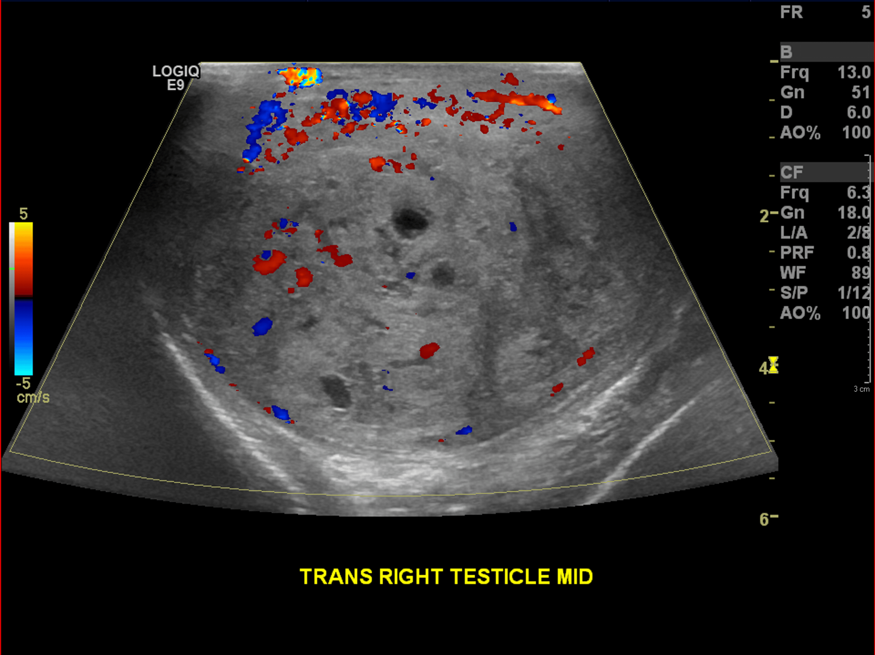 Cureus A Rare Case of Postorchidectomy Arterial Injury With Rapidly Enlarging Scrotal