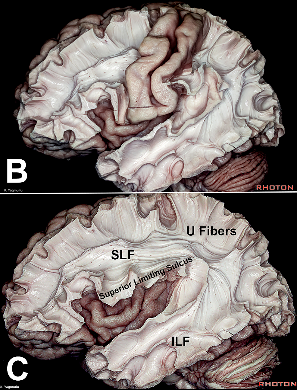 Dissections-showing-the-primary-motor-and-sensory-regions-around-the-central-sulcus,-and-subcortical-deep-white-matter-fibers
