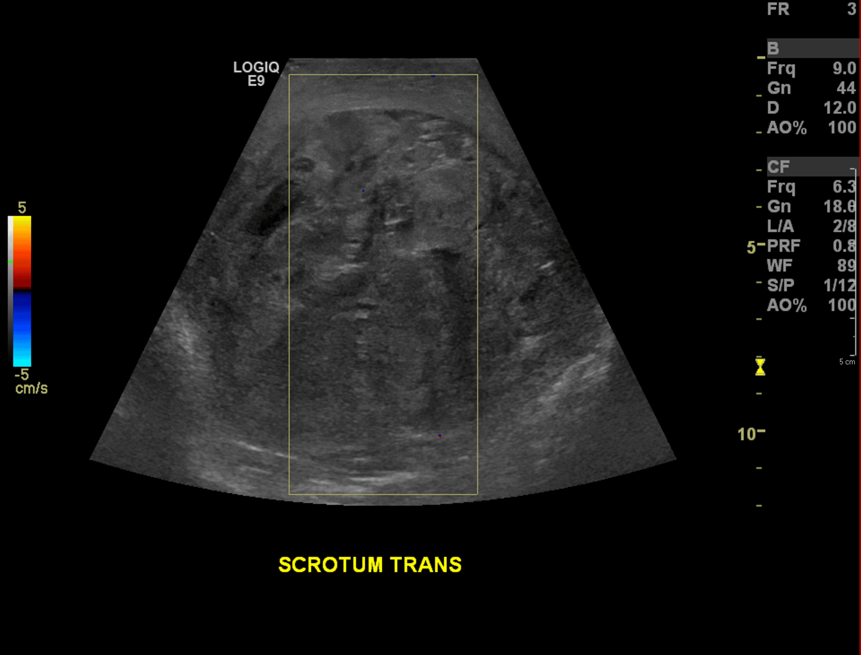 Cureus A Rare Case of Postorchidectomy Arterial Injury With Rapidly Enlarging Scrotal