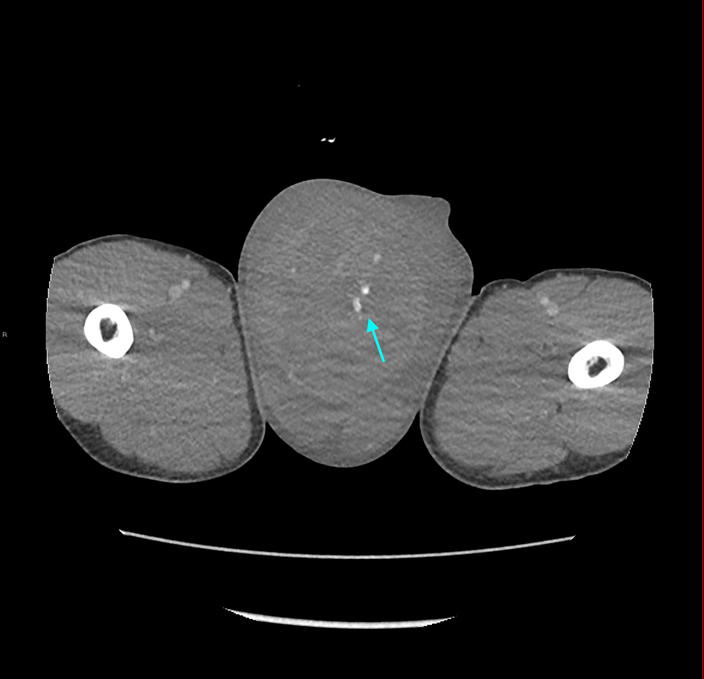 Cureus A Rare Case of Postorchidectomy Arterial Injury With Rapidly Enlarging Scrotal