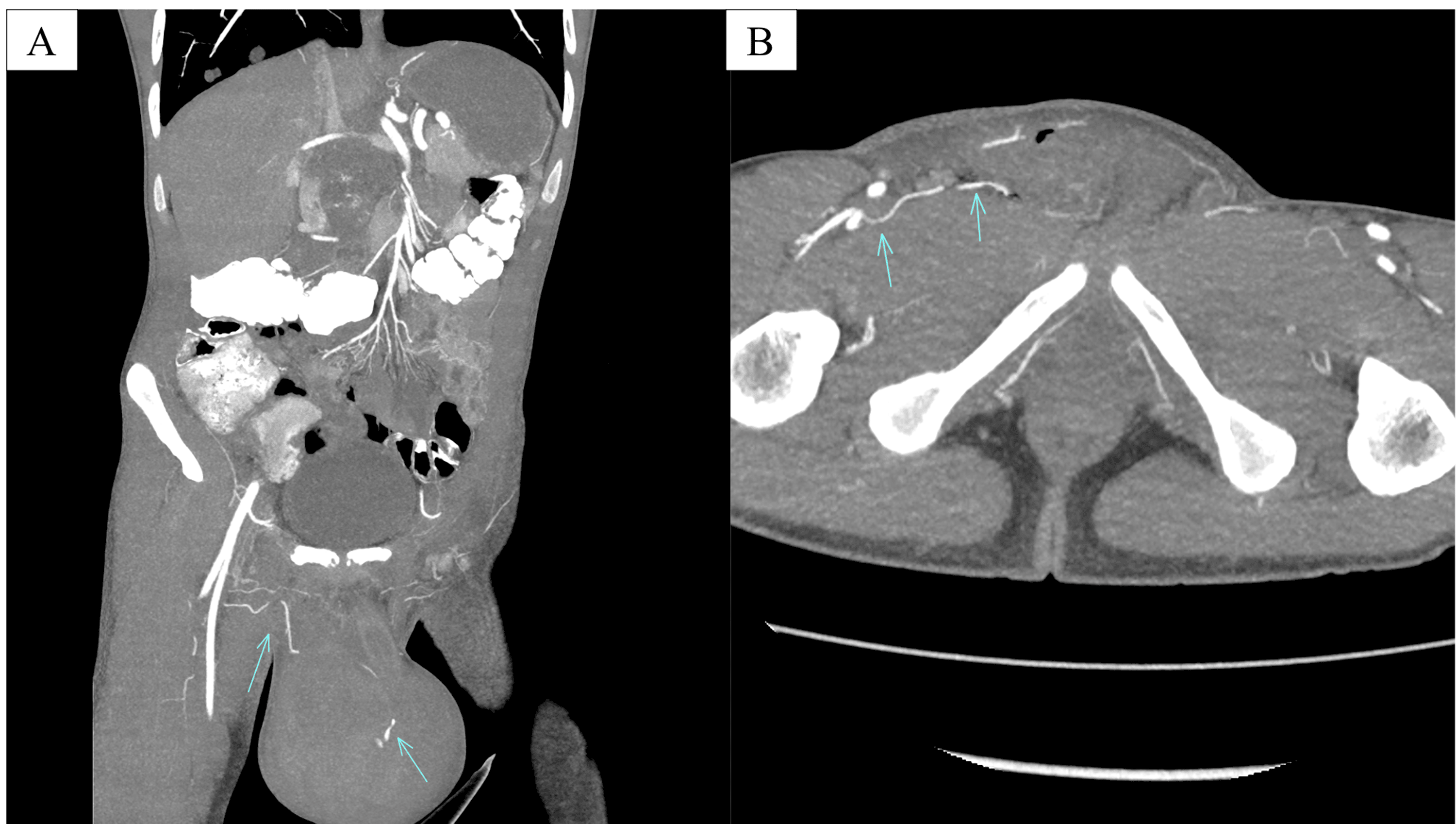 Cureus A Rare Case of Postorchidectomy Arterial Injury With Rapidly Enlarging Scrotal