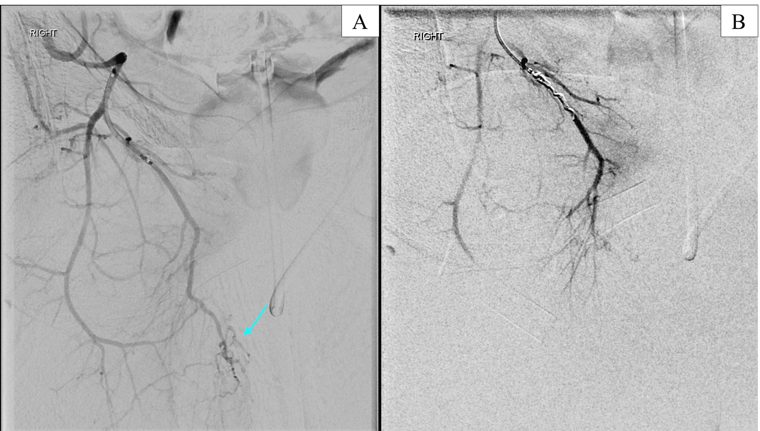Cureus A Rare Case of Postorchidectomy Arterial Injury With Rapidly Enlarging Scrotal