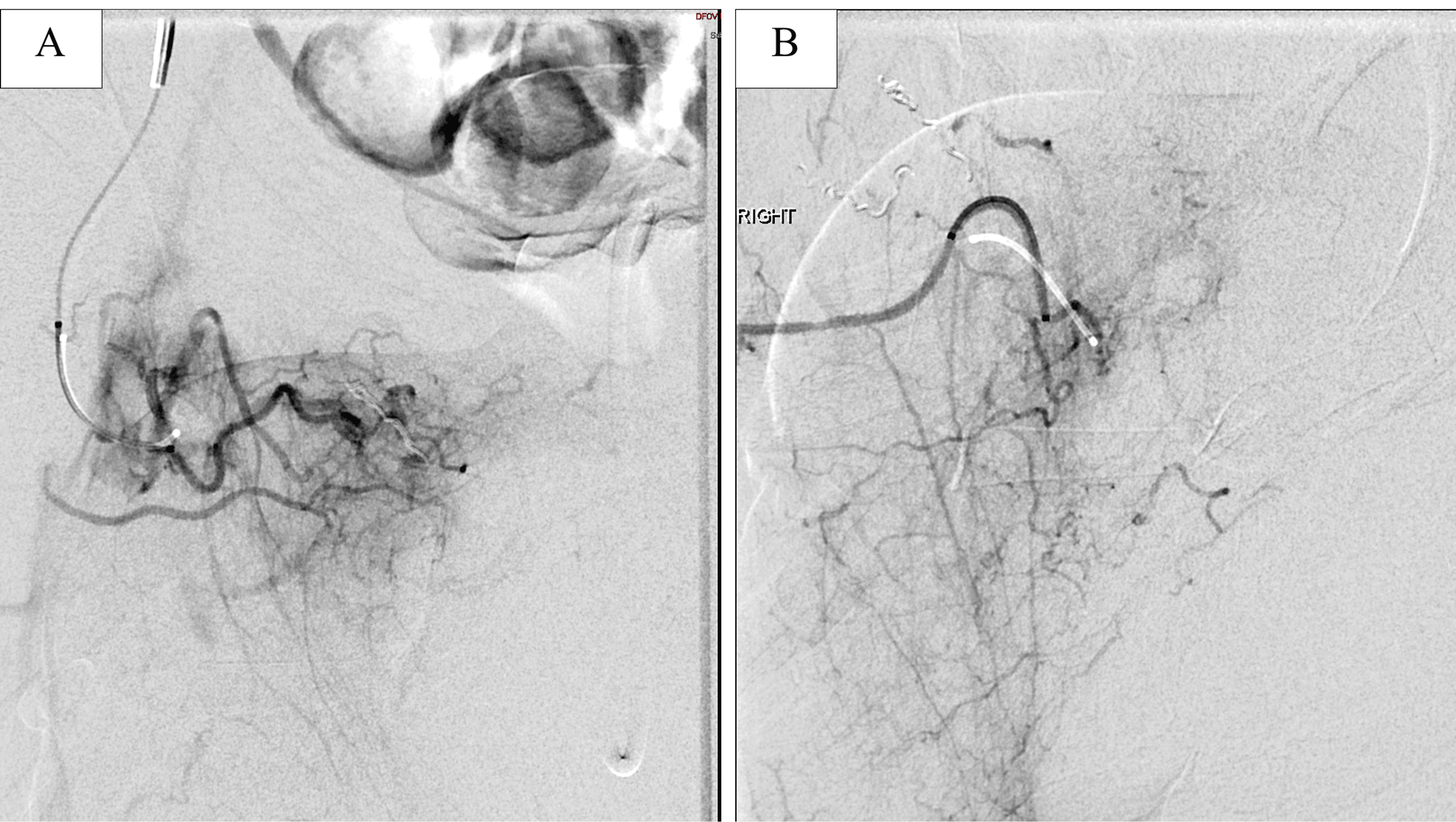 Cureus A Rare Case of Postorchidectomy Arterial Injury With Rapidly Enlarging Scrotal