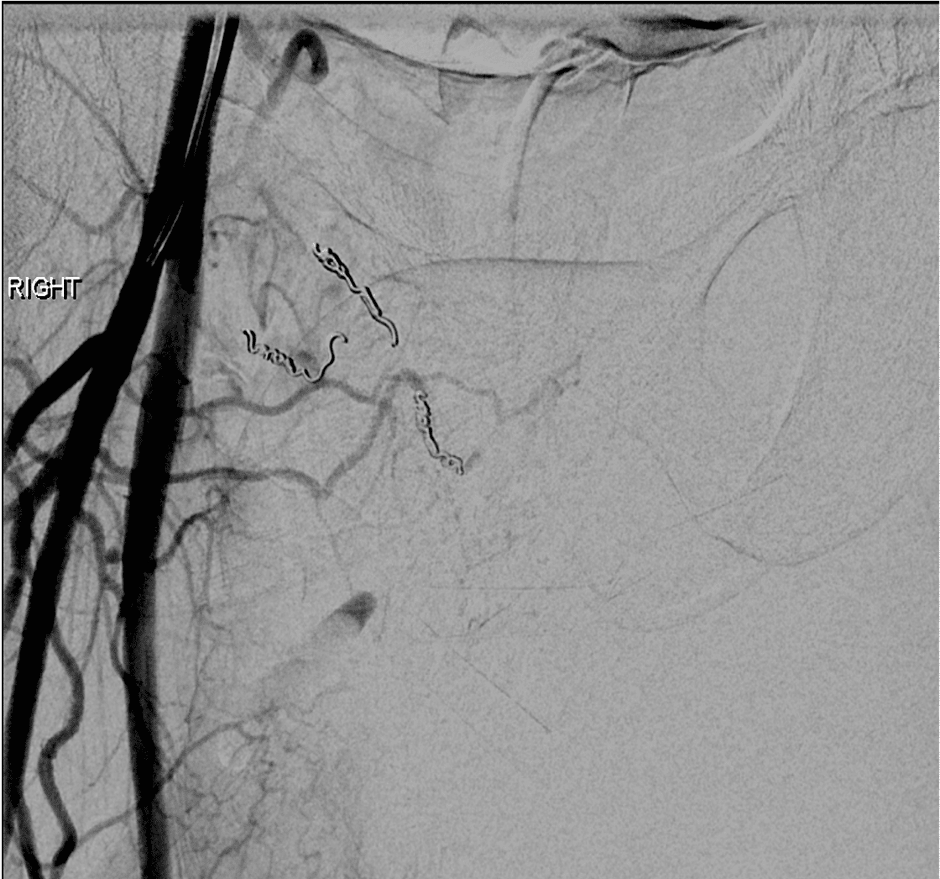 Cureus A Rare Case of Postorchidectomy Arterial Injury With Rapidly
