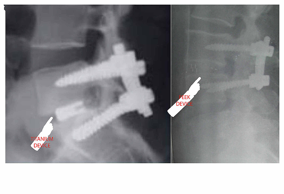 Cureus Evaluation of Titanium Serum Levels in Patients After Spine
