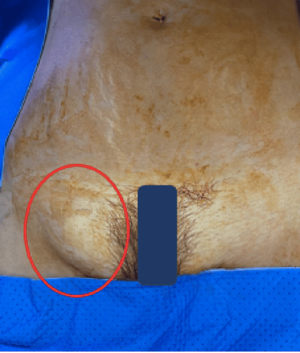 A: large femoral hernia in a female patient. B: the hernia sac with its