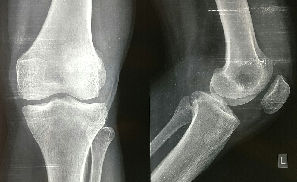 Cureus | Pigmented Villonodular Synovitis of the Knee Joint: A Case Report