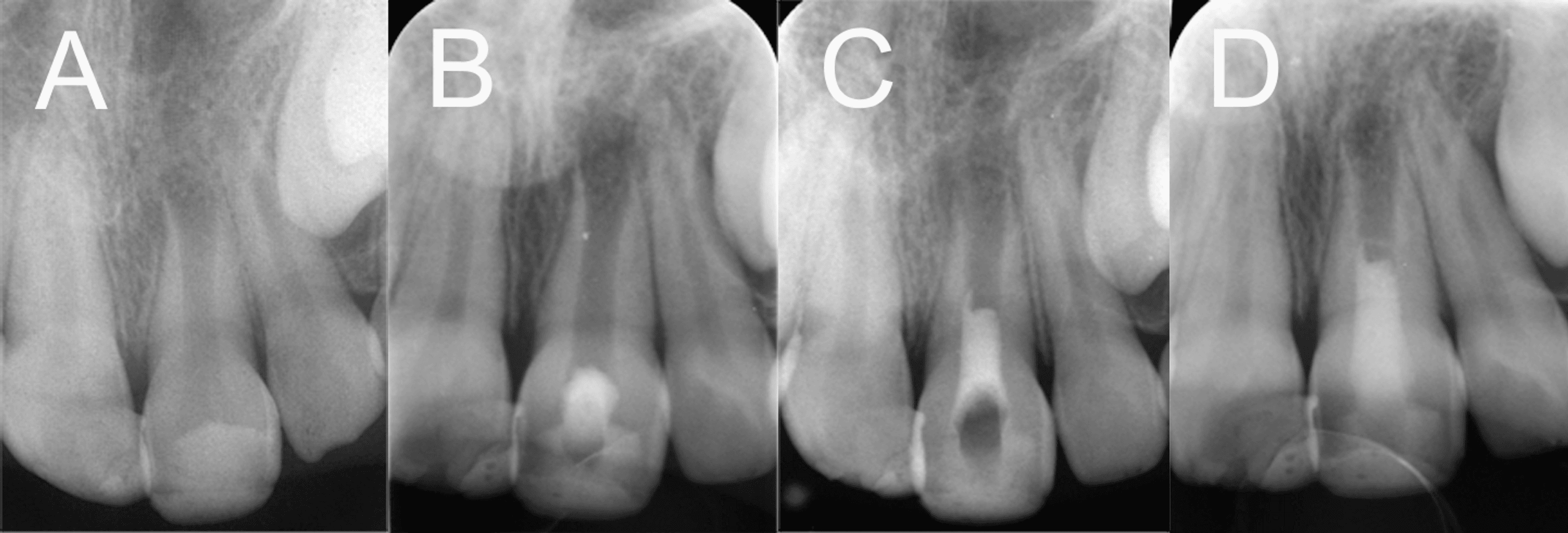 Impact of Orthodontic Treatment on Regenerative Endodontics in Immature