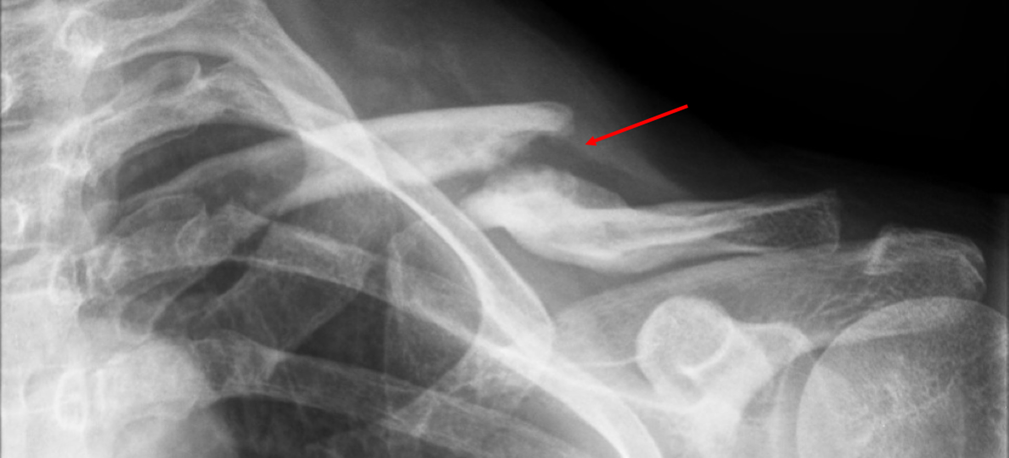 Cureus Acute Surgery vs. Nonunion Surgery of Displaced Midshaft