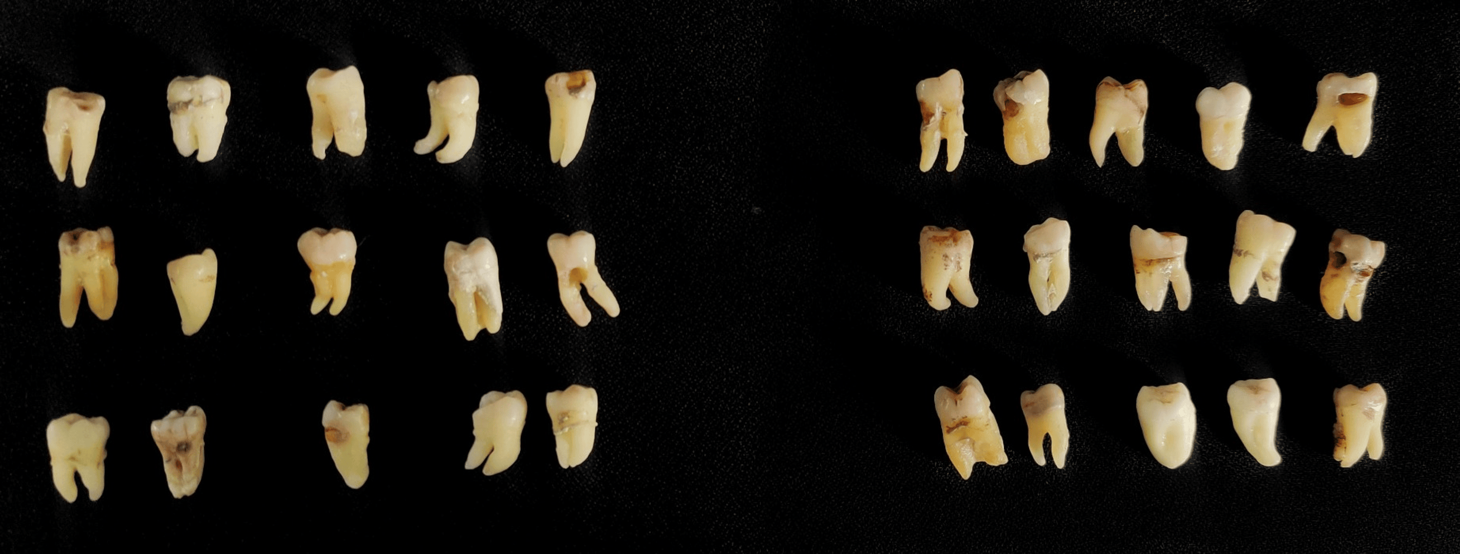 Assessment of Smear Layer Formation After Caries Removal Using Erbium