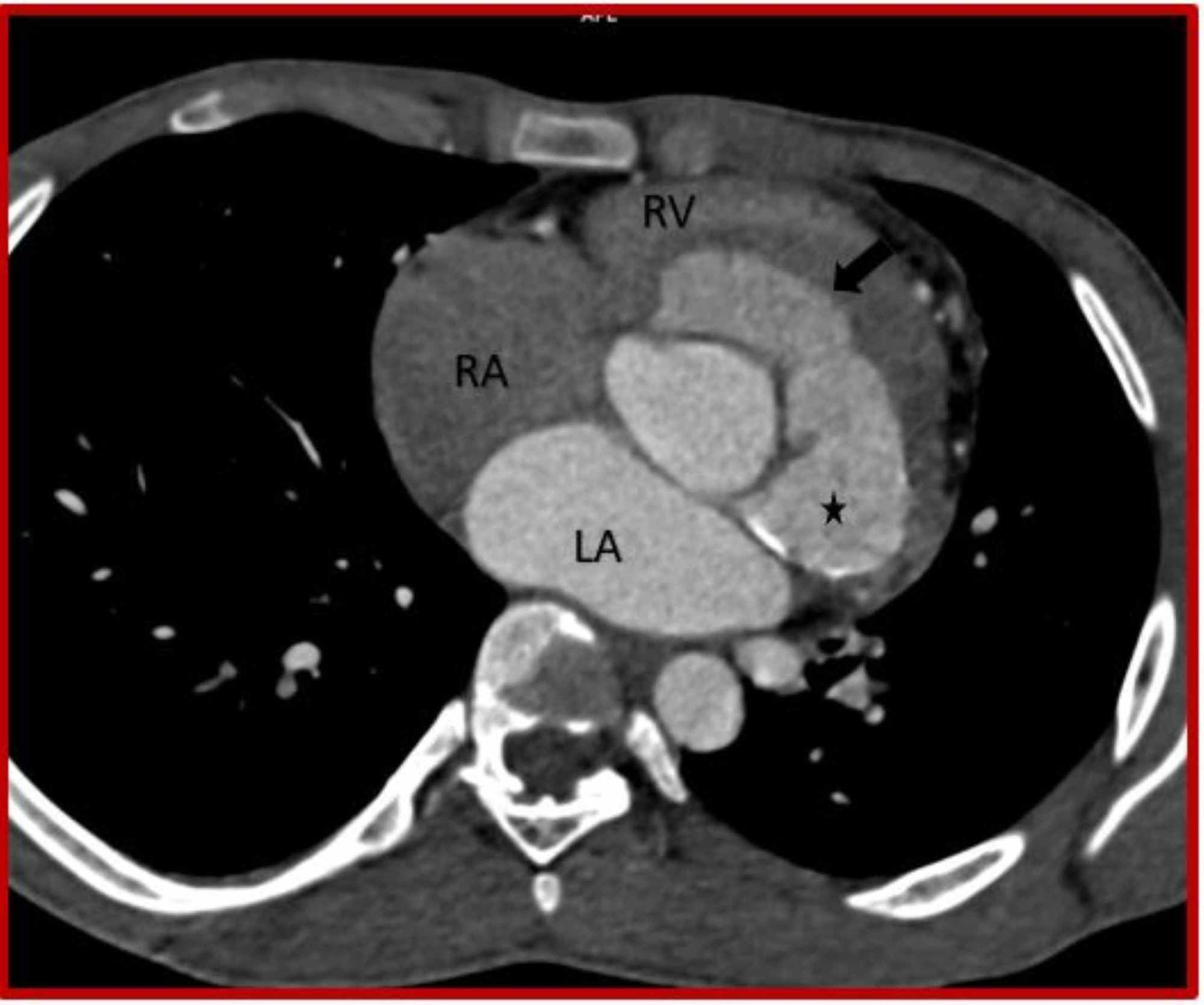 Cureus Rupture Of Sinus Of Valsalva Aneurysm Into Interventricular Septum Role Of Cardiac Ct