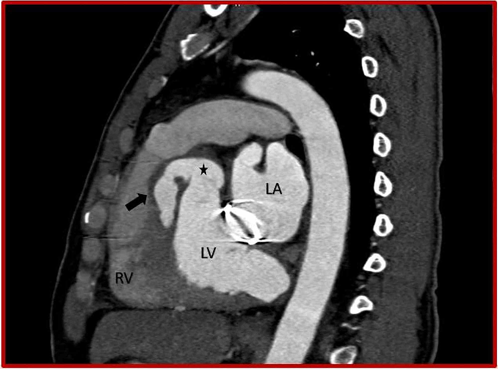 Cureus Rupture of Sinus of Valsalva Aneurysm into Interventricular Septum Role of Cardiac CT