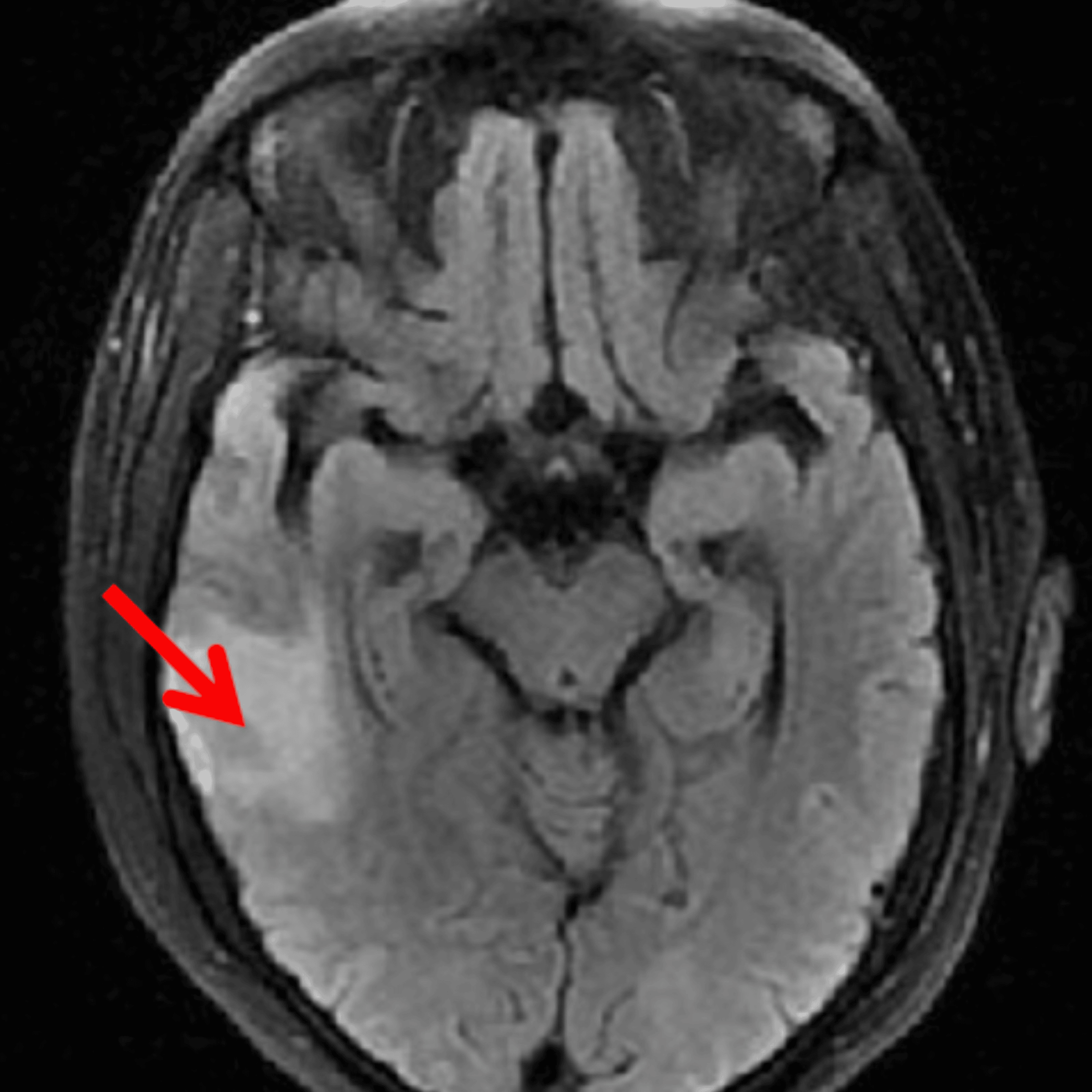 Cureus Protein S Deficiency A Case Report
