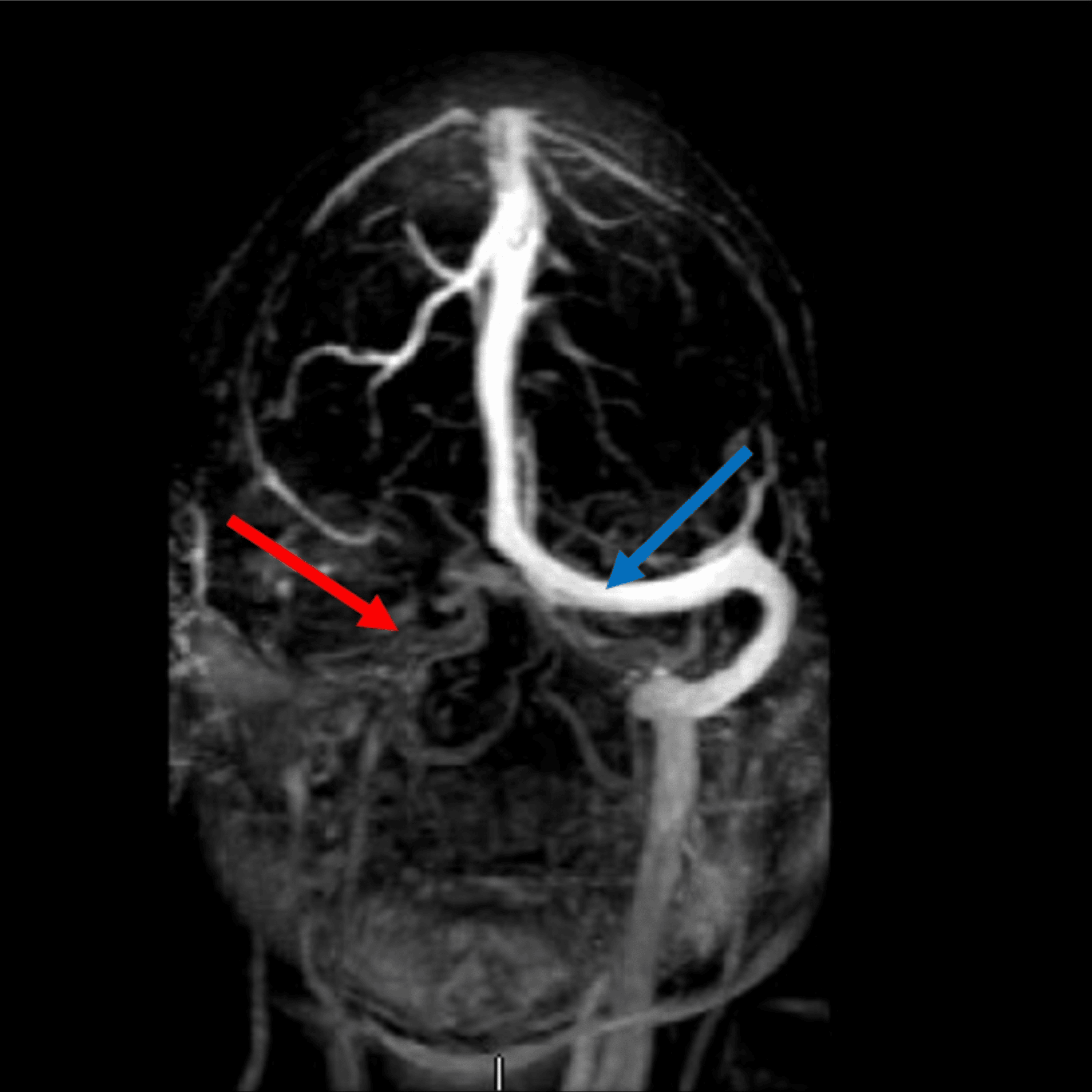 Protein S Deficiency A Case Report Cureus