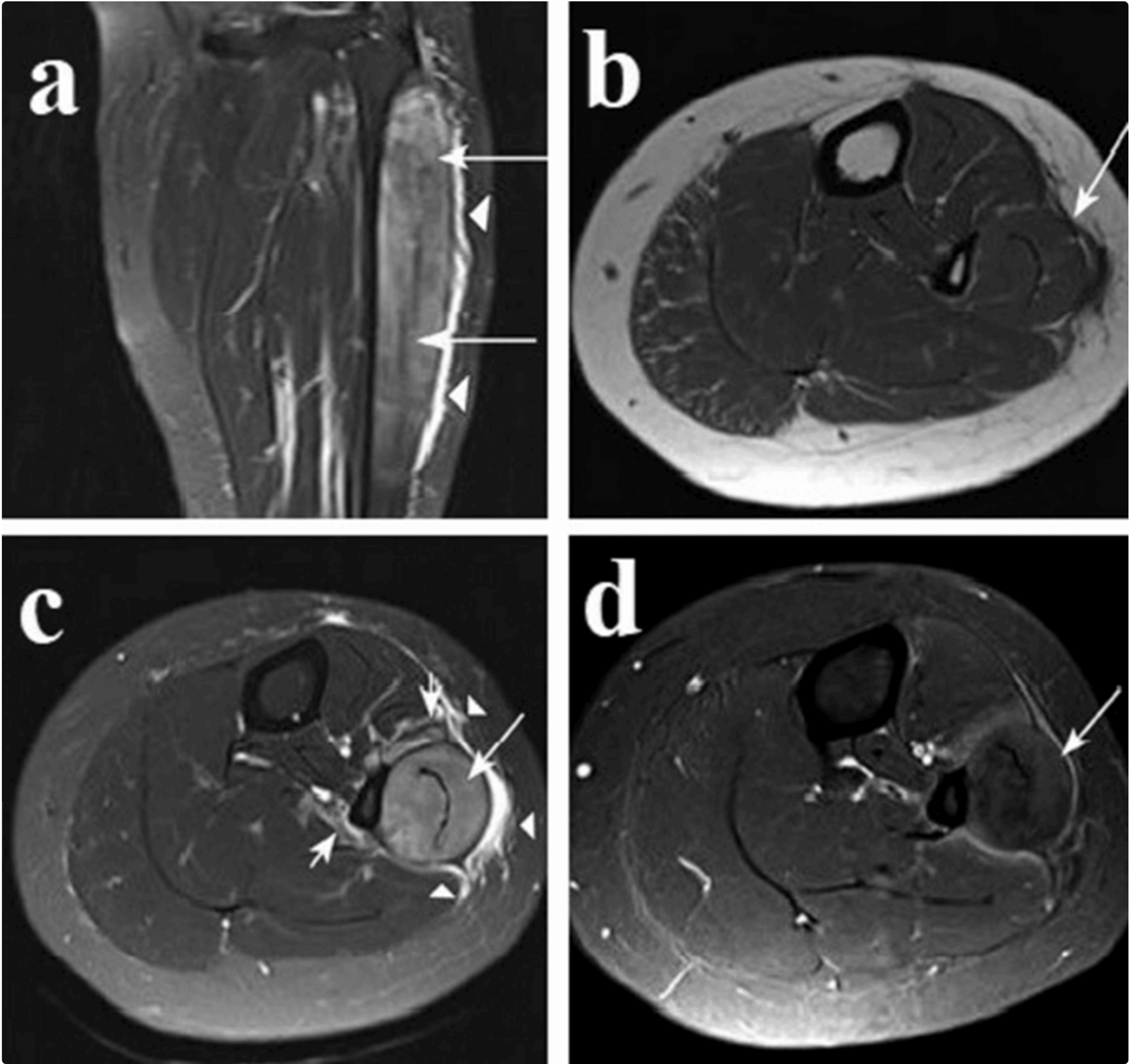 Cureus Chronic Exertional Compartment Syndrome in Athletes An