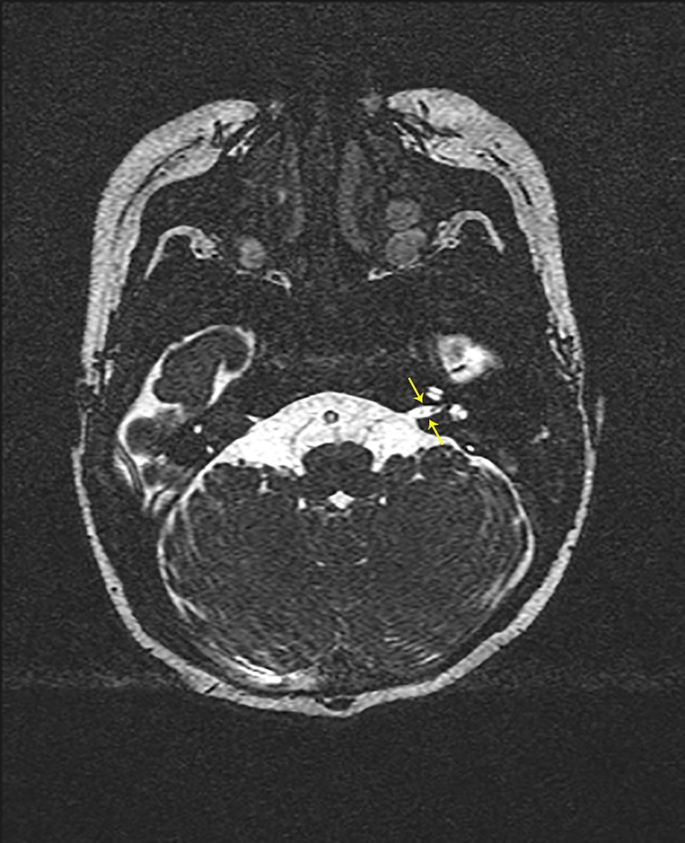 mri of internal auditory canal images which cranial