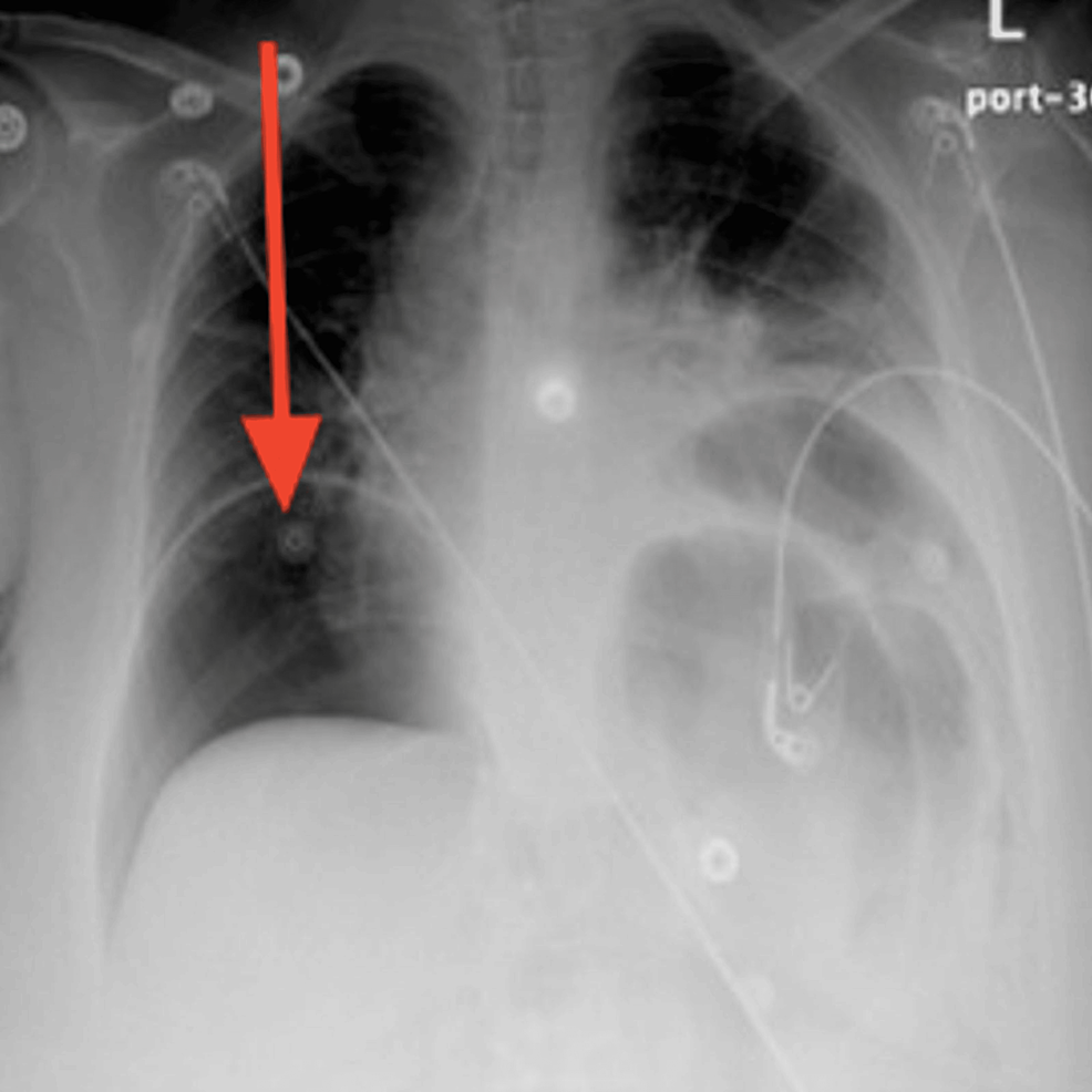 Posteroanterior-chest-X-ray-at-the-time-of-gastric-perforation-displaying-severe-air-under-the-diaphragm-with-bilateral-obstruction-indicating-massive-pneumoperitoneum-(red-arrow)
